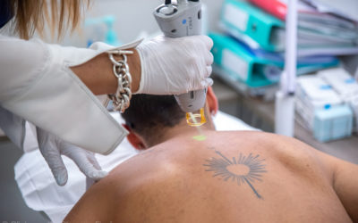 L’épilation laser pour les hommes