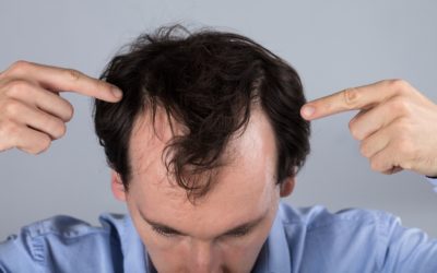 Quand doit-on se faire implanter des cheveux ?