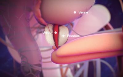 Cancer de la prostate : comment réduire les risques ?